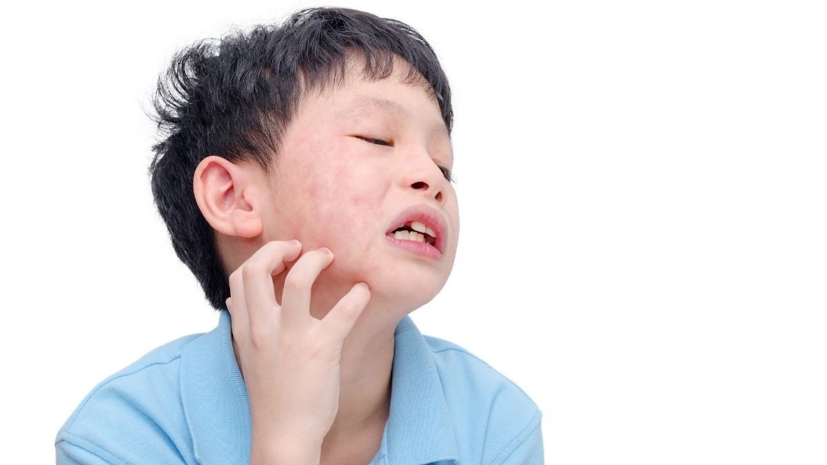 Pengobatan Alami untuk Anak Alergi