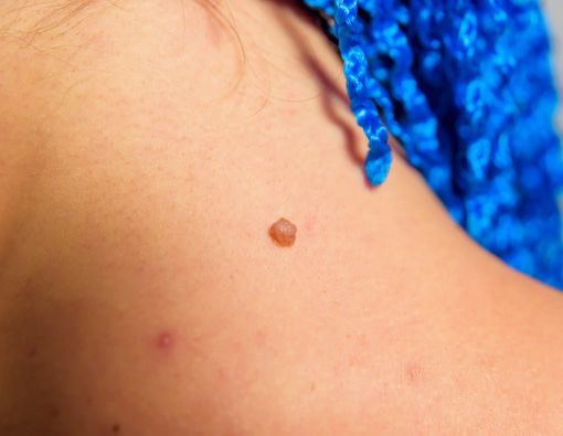 Benarkah Tahi Lalat Bisa Berkembang Jadi Kanker Kulit?