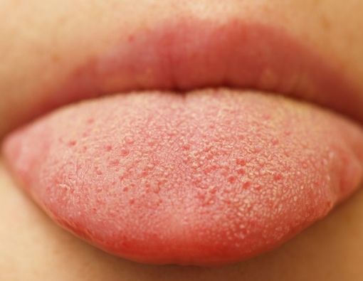 Penyebab dan Gejala Scalloped Tongue, Kondisi Lidah Bergigi
