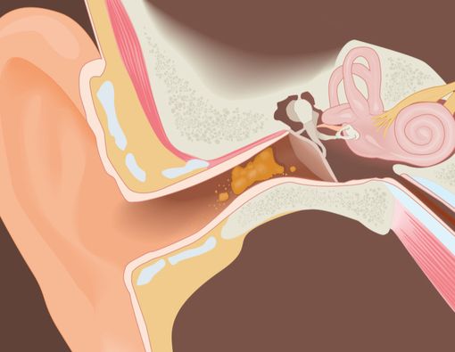 Kotoran Telinga, Beda Warna Beda Arti