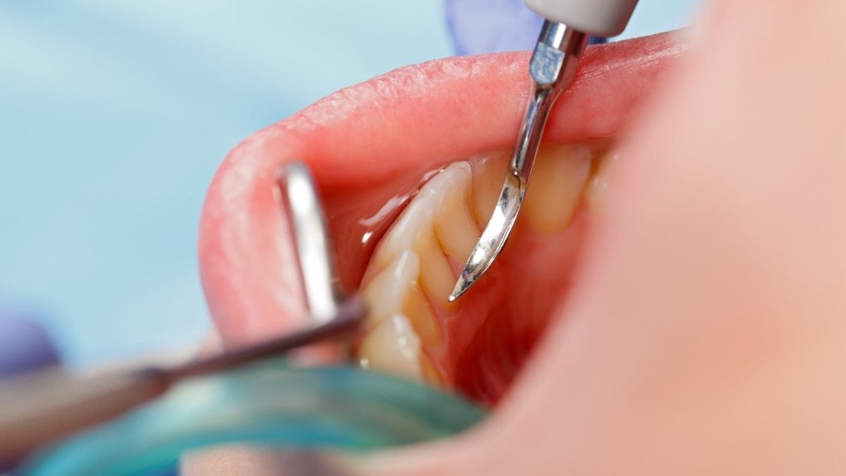 Berbagai Cara Mencegah Karang Gigi yang Mudah Dilakukan