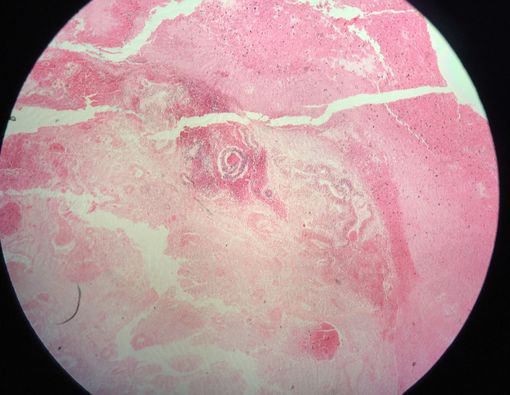 Sering Dikira Santet, Ini Penjelasan Medis Penyakit Teratoma