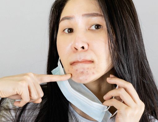 Skindemik? Efek Samping yang Muncul Saat Situasi Pandemi