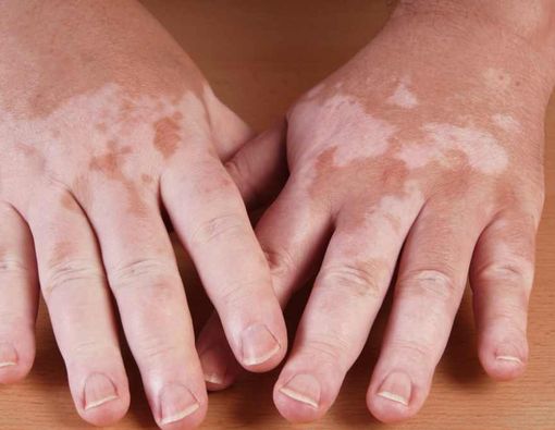 Waspadai 5 Gejala Vitiligo pada Kulit!