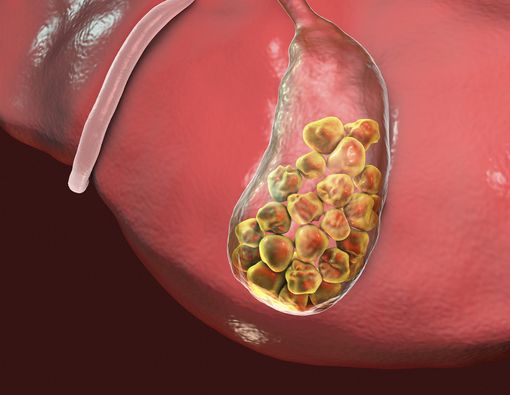 Cegah Batu Empedu dengan Diet Sehat