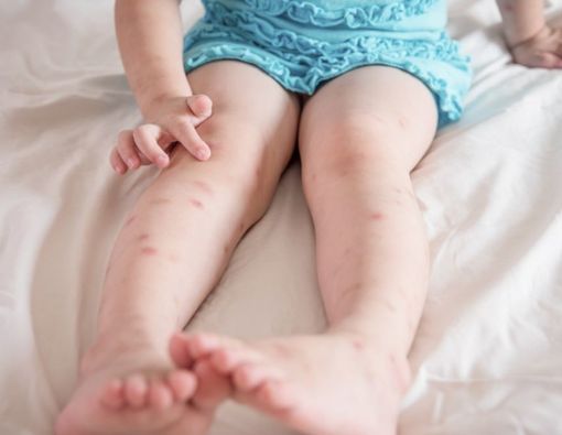 Alasan Medis Bentol Akibat Gigitan Nyamuk Terasa Gatal