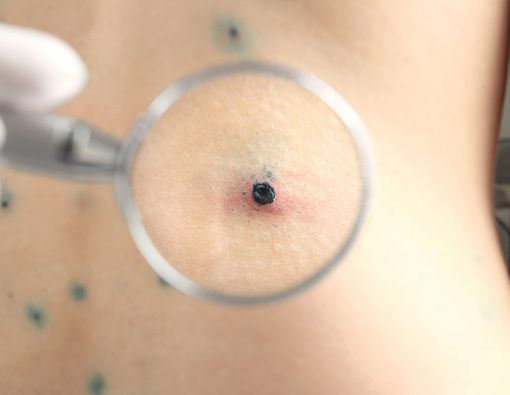 Fakta di Balik Mitos Populer Seputar Cacar Air