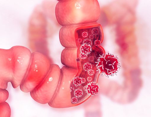 Kaitan Kopi, Teh, dan Minuman Bersoda Terhadap Kanker Kolon