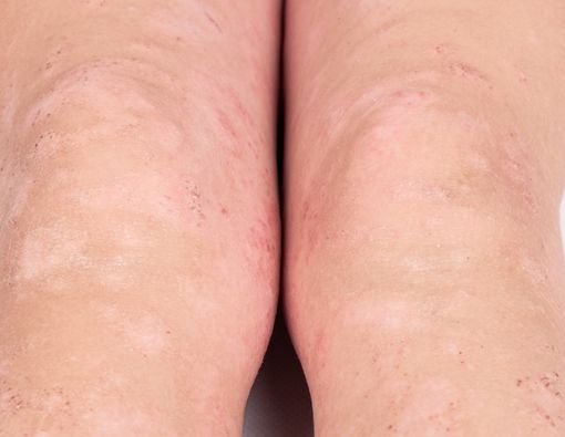 Cara Menangani Anafilaksis Pada Anak