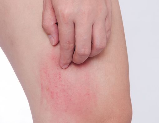 Terlalu Banyak Zat Besi Sebabkan Infeksi pada Kulit?