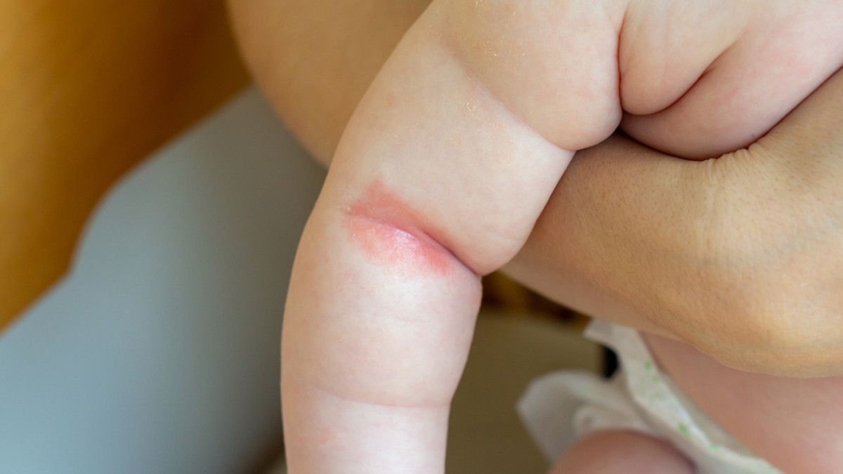 Psoriasis Bisa Terjadi pada Bayi, Kenali Gejalanya!