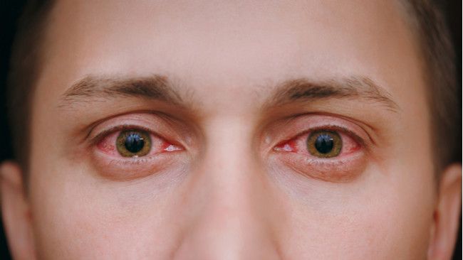 Mata Merah, Akibat Alergi atau Faktor Lain?