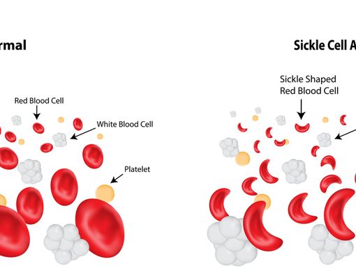 Anemia Sel Sabit, Berbahayakah?
