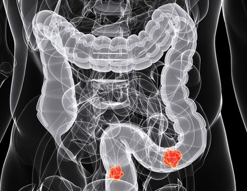 Ini Gejala Kanker Usus yang Dialami Istri Ustaz Maulana