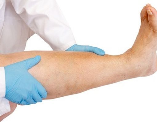 5 Tips Atasi Kaki Bengkak saat Hamil