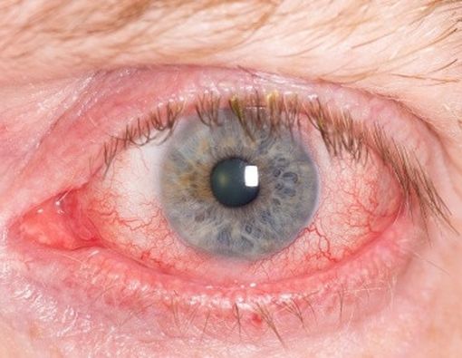 Inilah Penyebab Mata Merah &amp; Iritasi