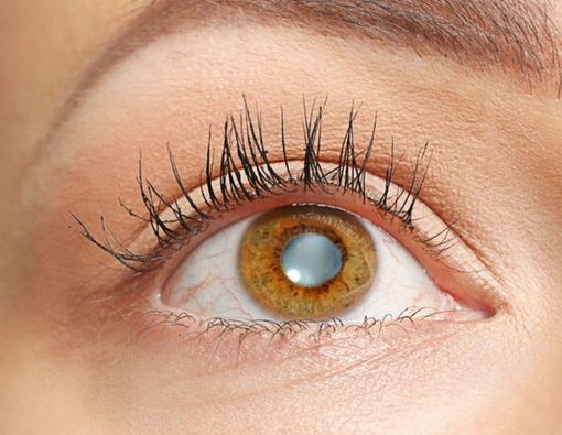 Kenali Penyebab Katarak agar Bisa Dicegah dari Sekarang