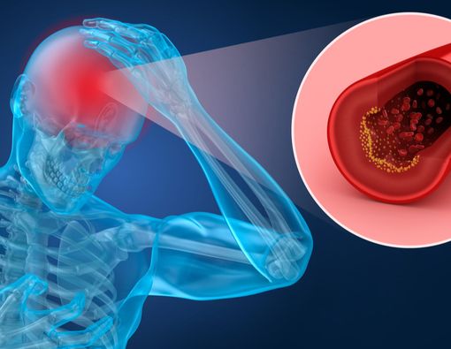 Cara Mengatasi Hilang Ingatan bagi Penderita Stroke