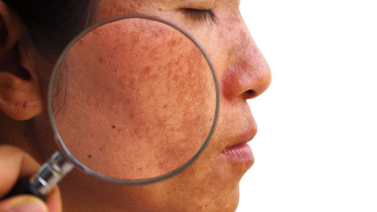Benarkah Melasma Bisa Memicu Kanker Kulit?