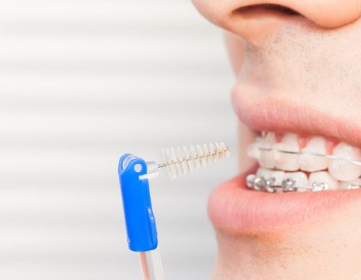 Untuk Pemula, Ini Tips Merawat Gigi dengan Behel