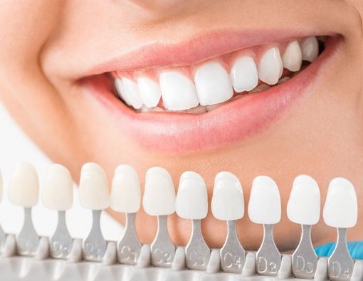 Punya Masalah Gigi Sensitif, Bolehkah Memutihkan Gigi?