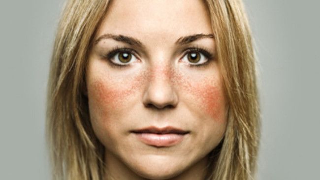 Ini Alasan Mengapa Wanita Lebih Rentan Kena Penyakit Lupus