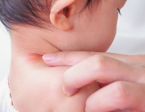 Panu pada Anak, Pahami Gejala, Penyebab, dan Cara Mengobatinya