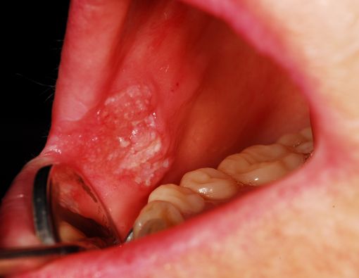 Kanker Lidah Bisa Sebabkan Kematian.  Apa Pemicunya?