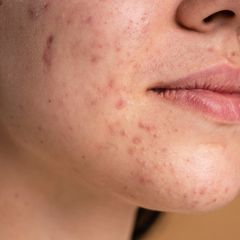 8 Obat Jerawat Alami yang Bisa Dicoba di Rumah
