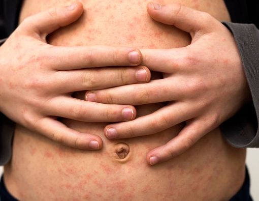 Penting untuk Tahu, Penyebab dan Cara Penularan Rubella (Campak Jerman)