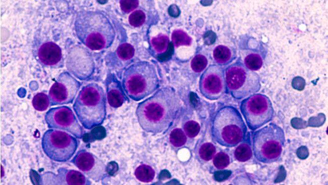 Yuk, Kenali Penyakit Multiple Myeloma Lebih Jauh!