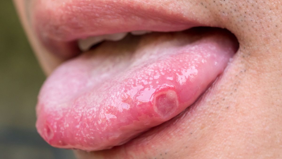 Ini Cara Mengatasi Sariawan Lidah