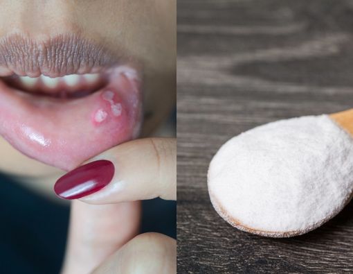 Mengatasi Sariawan dengan Baking Soda, Apakah Efektif?