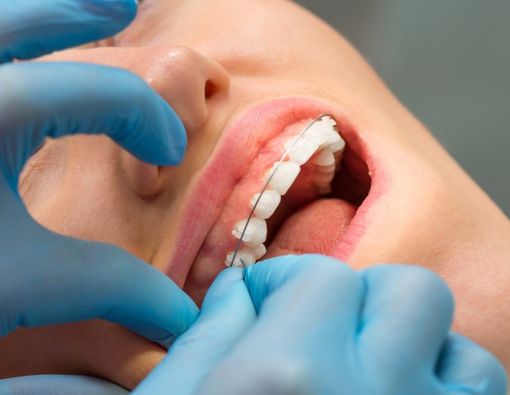 Waspadai Jasa Pemasangan Behel Gigi di Situs Jejaring Sosial