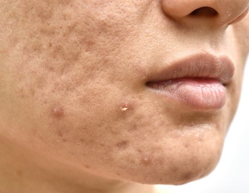 Mengenal Jenis Bopeng dan Acne Scars pada Wajah