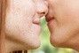 Hati-Hati, Ciuman Bisa Menularkan Herpes!