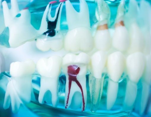 Tahapan Kerusakan Gigi dan Perawatan yang Bisa Dilakukan