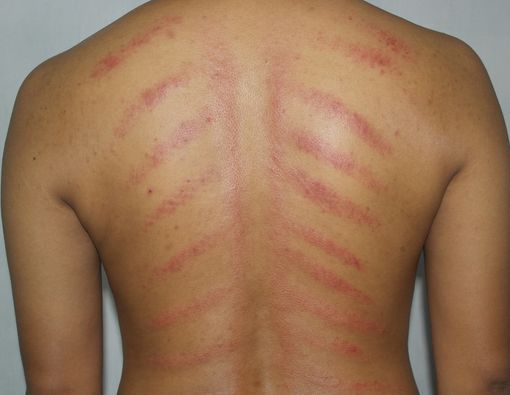 Kerokan Bawang Merah untuk Mengatasi Masuk Angin, Benarkah Ampuh?