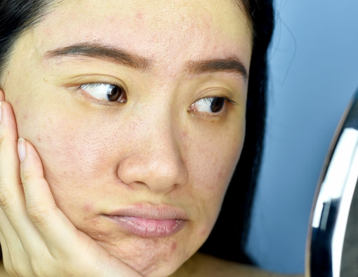 Tanda-Tanda Wajah Rusak Karena Merkuri