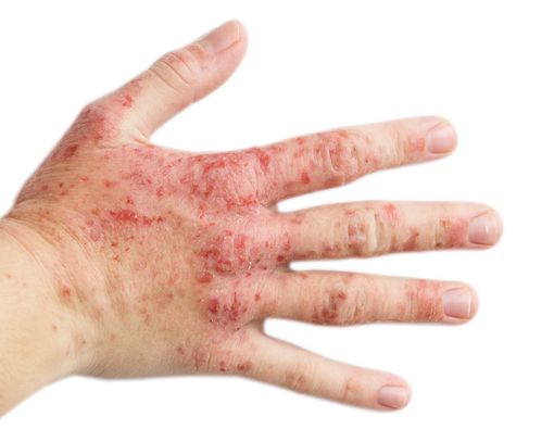 Ruam Akibat Corona Bisa Bertahan Lama