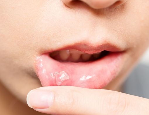 Perbedaan Sariawan Biasa dengan Gejala COVID-19