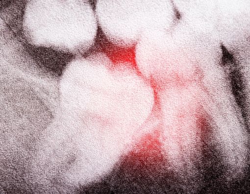 Penyebab Impaksi Gigi yang Harus Kamu Waspadai