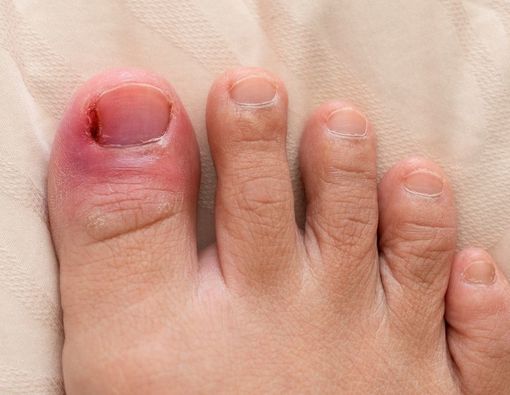 Jari Bengkak dan Merah Karena Udara Dingin, Awas Terkena Chilblains