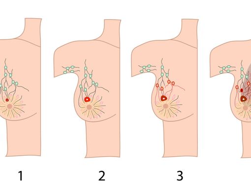 Ciri-ciri Kanker Payudara Sesuai Stadium
