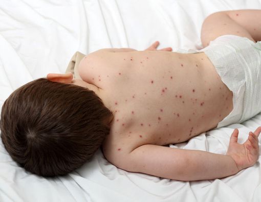 Kenali Gejala Cacar Air dan Pengobatannya