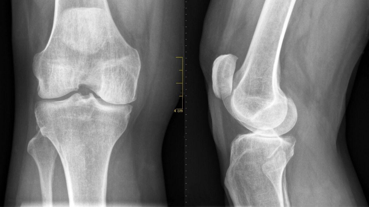 Jenis Tulang Rawan dan Kondisi Kesehatan yang Dapat Terjadi