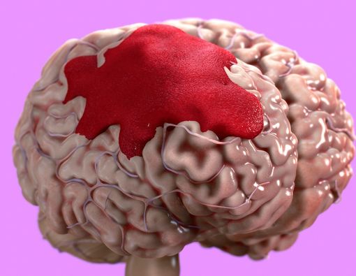 Penyebab Pendarahan Otak atau Hemoragik