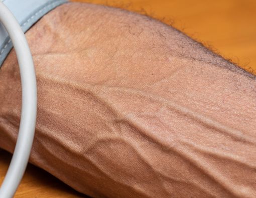 Penyebab Urat Menonjol dan Tampak di Kulit