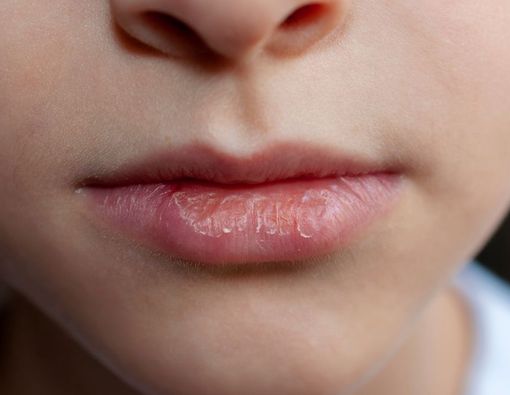 Xerostomia (Mulut Kering)