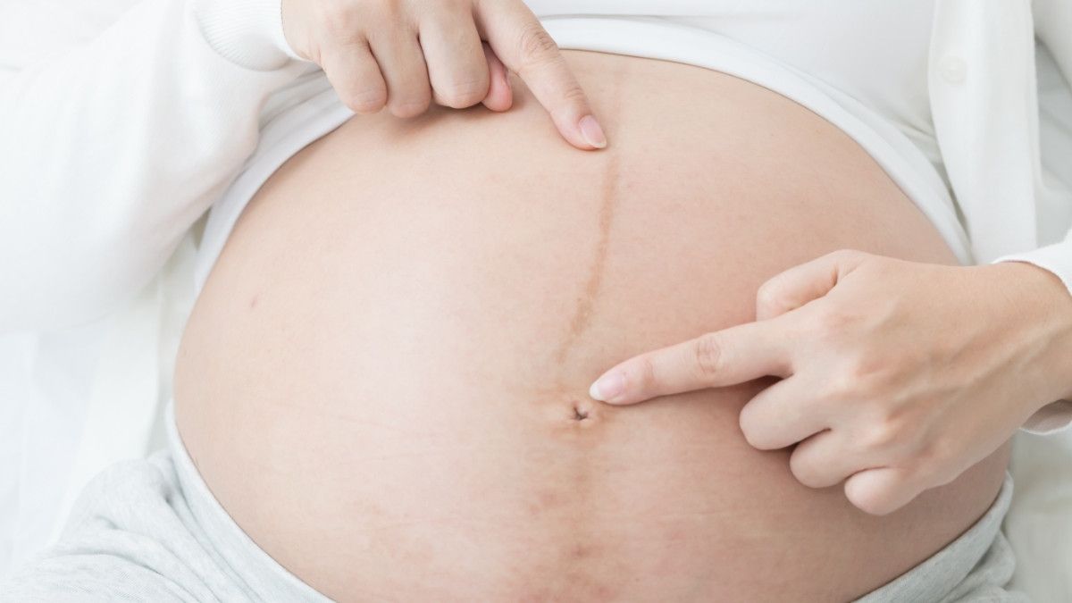 Mengenal Linea Nigra, Garis Hitam di Perut Saat Hamil